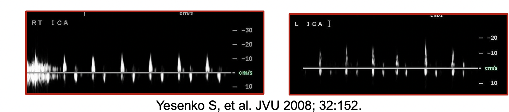 <p>When would you see this waveform in the ICA</p>
