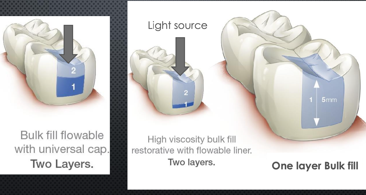 <p>Flowable at bottom and then packable on top</p><p>Or One layer of bulk fill</p>