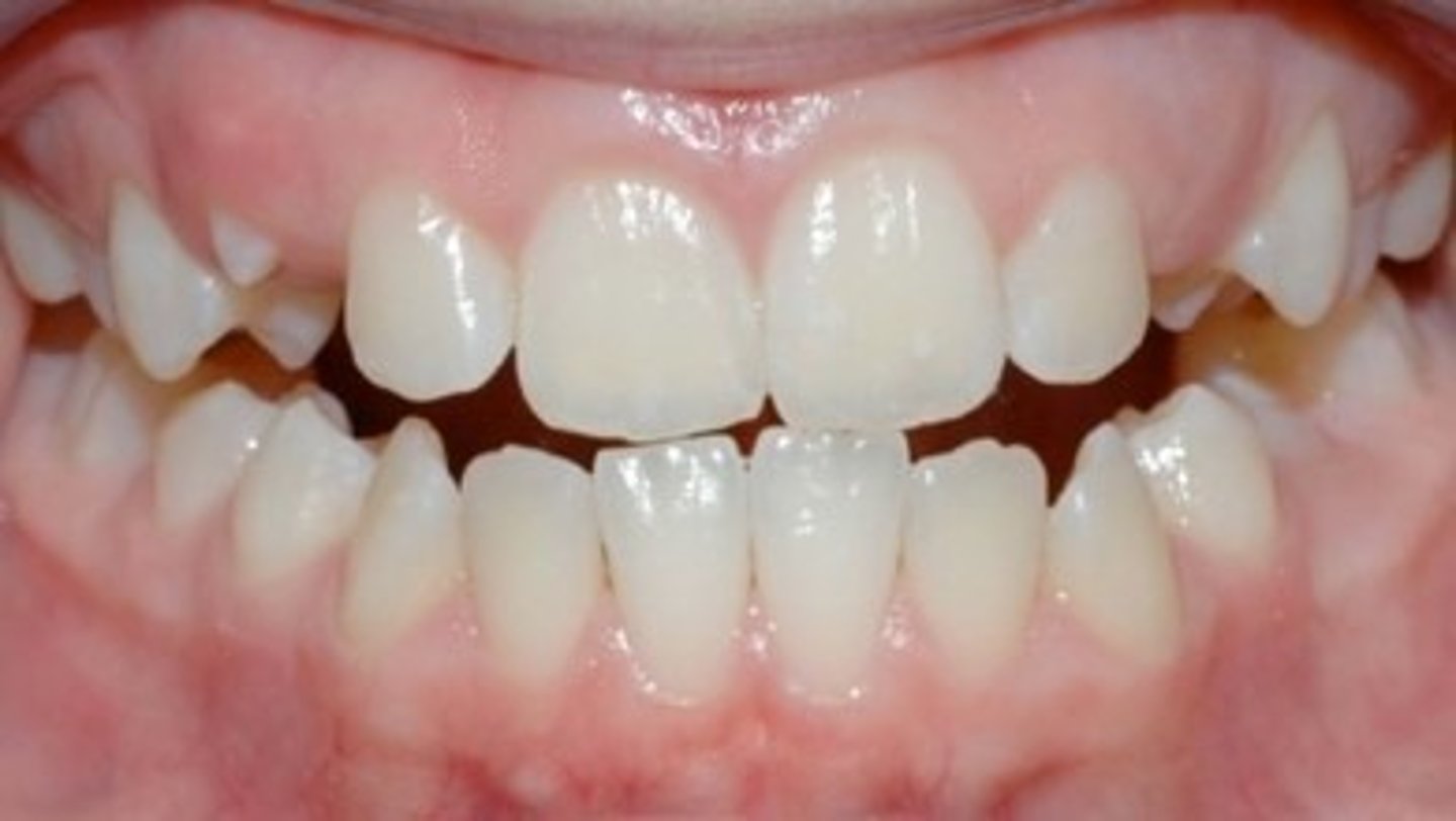 <p>What is this called for the anterior teeth?</p>