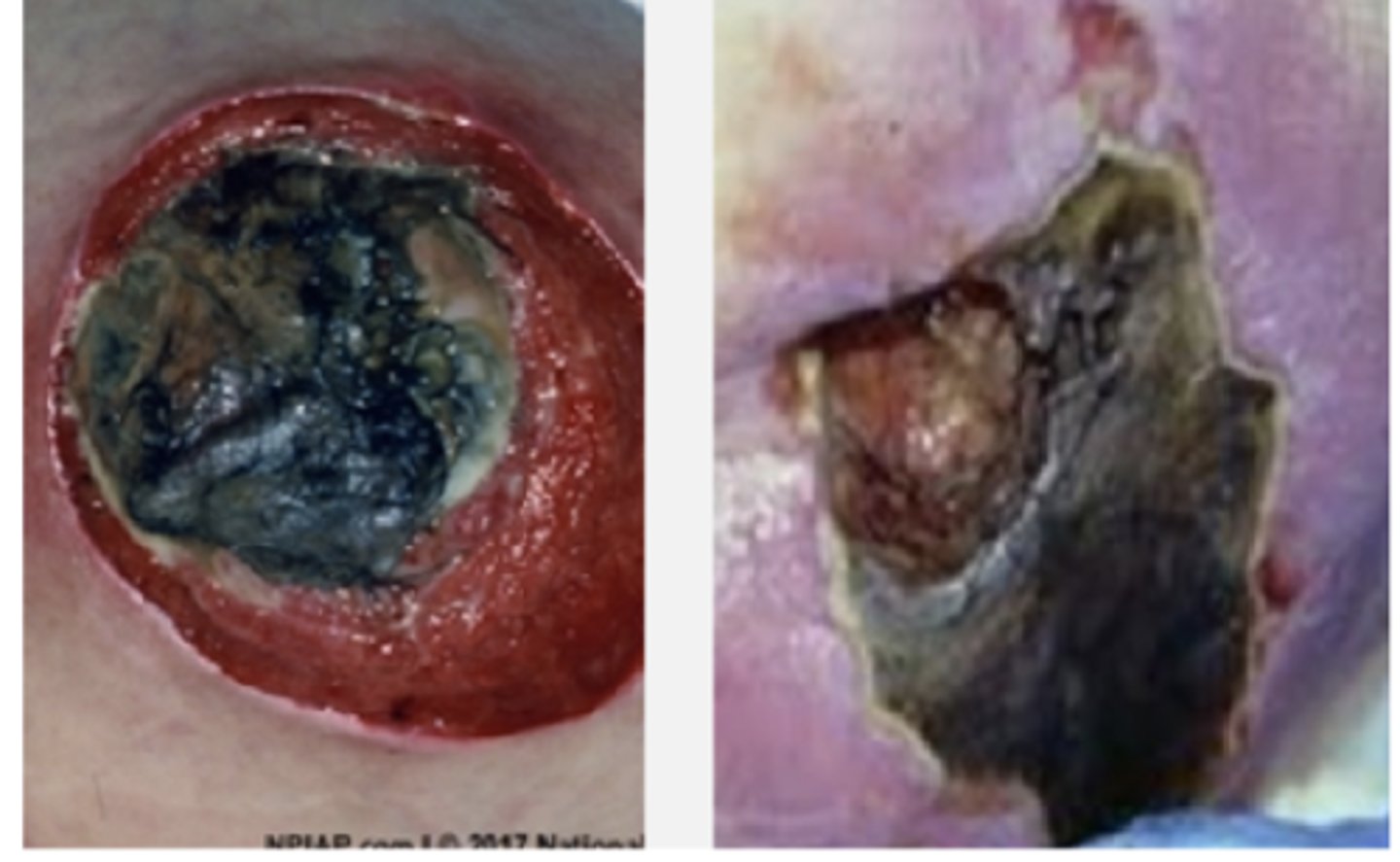 <p>Localized area of tissue necrosis covered with slough or escar</p>