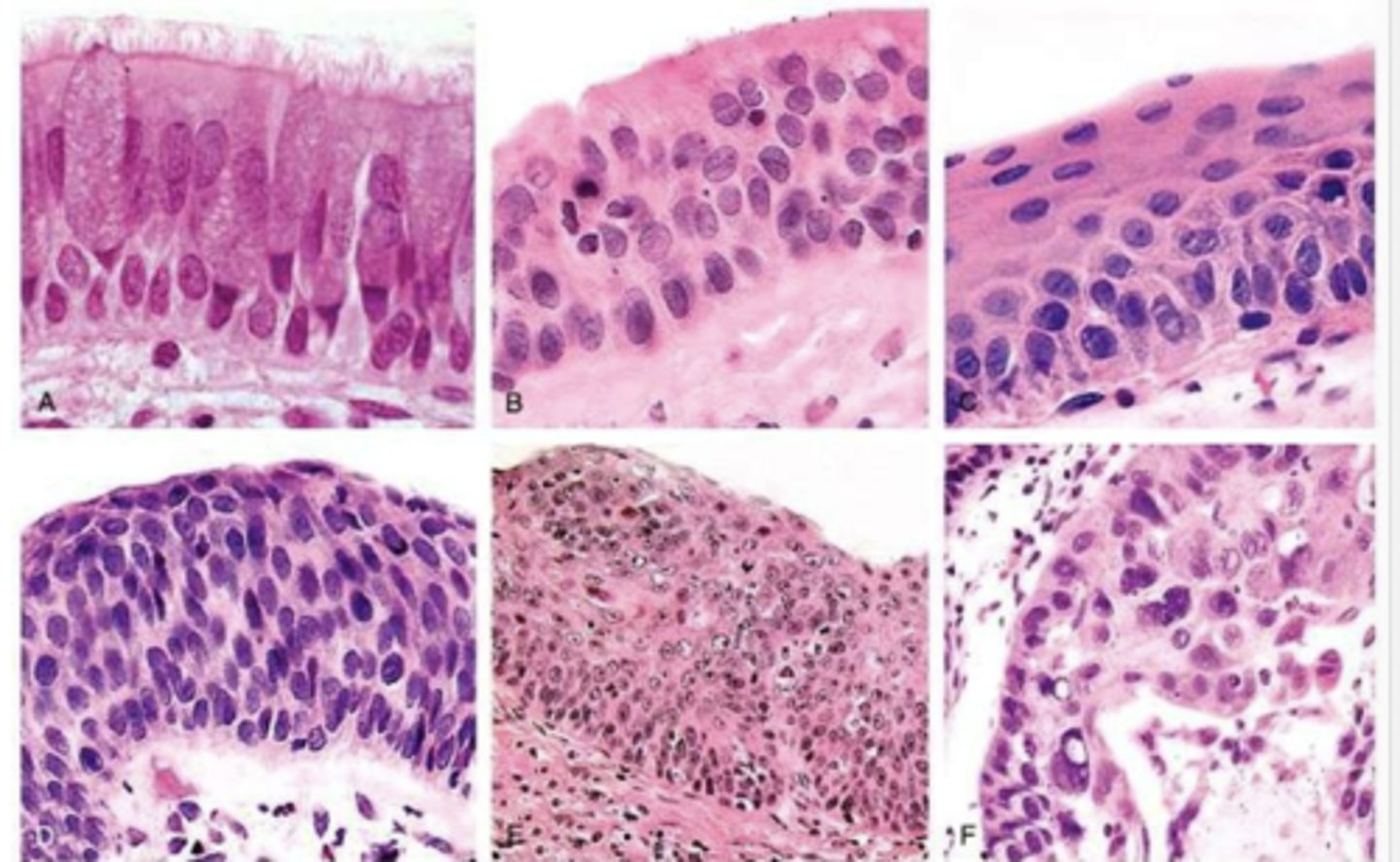 <p>arises centrally in major bronchi</p>