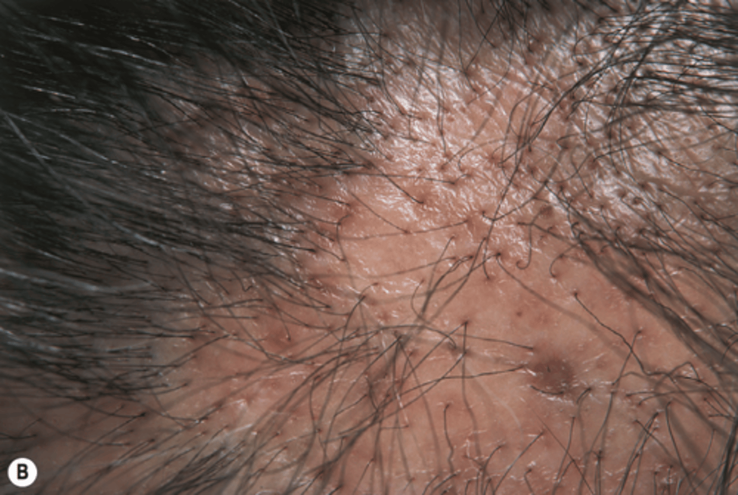 <p>Lichenplano pilaris (follicular)</p>