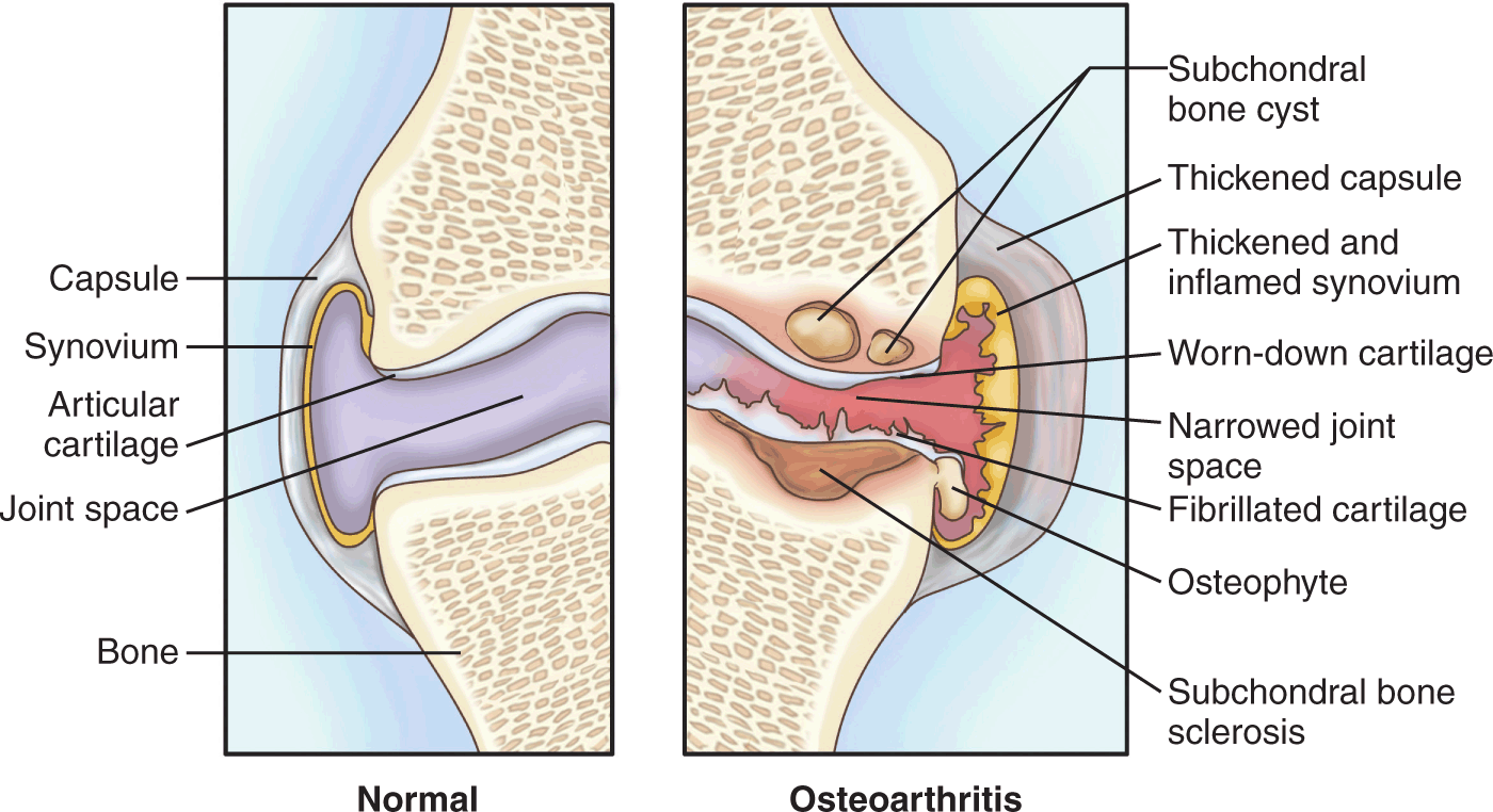 <p>Subchondral bone cyst</p><p>Thickened capsule</p><p>Thickened and inflamed synovium</p><p>Worn-down cartilage</p><p>Narrowed joint space</p><p>Fibrillated cartilage</p><p>Osteophyte</p><p>Subchondral bone sclerosis</p>