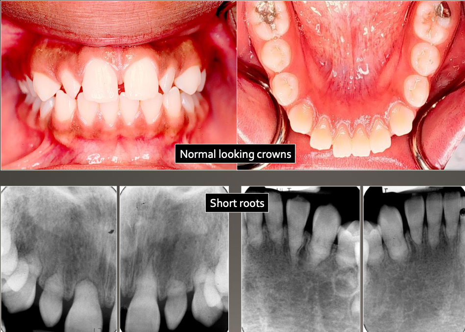 <p>Primary Dentition</p><ul><li><p>Blue-amber-brown translucence</p></li><li><p>Bulbous crown</p></li><li><p>cervical constriction</p></li><li><p>thin roots, normal length</p></li><li><p>early obliteration of pulp</p></li></ul><p>Permanent Dentition</p><ul><li><p>Normal color clinically</p></li><li><p>Pulp chamber is enlarged = thistle tubs or flames shaped</p></li><li><p>Pulp stone</p></li><li><p>Normal Root</p></li></ul><p></p>