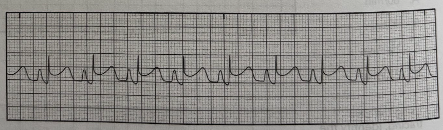 <p>Which of the following abnormal waveforms is shown in the EKG tracing below and requires immediate emergent treatment of the patient?<br>A. Prolonged QRS complex </p><p>B. ST segment depression</p><p>C. Prolonged PR interval</p><p>D. ST segment elevation</p>