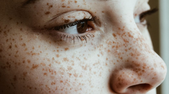 <p>Common Skin Variation</p><ul><li><p>Sun exposed skin</p></li><li><p>Common in Caucasians</p></li></ul><p></p>