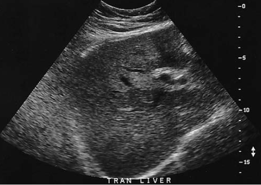 <p>an obese patient presents with history of elevated liver function tests discovered during a life insurance medical exam. the patient has no complaints. Sono of this image is most sus for</p>