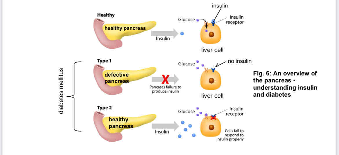 <ul><li><p>diabetes mellitus </p><ul><li><p>type 1 diabetes → pancreas fails to produce enough insulin </p></li><li><p>type 2 diabetes → person’s body cells no longer respond to insulin produced by the pancreas </p></li></ul></li><li><p>signs and symptoms: increase in blood glucose, glucose found in urine, excessive thirst and urination, tiredness, loss of weight</p></li><li><p>treatment </p><ul><li><p>injection of insulin (for Type 1 only)</p></li><li><p>controlled diet and exercise</p></li><li><p>taking medicine (e.g Metformin lowers glucose production in the liver and increases body’s sensitivity to insulin)</p></li></ul></li></ul>