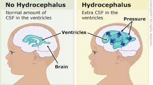 <ul><li><p>Extra CSF in the ventricles in the brain ("water on the brain")</p></li><li><p>Commonly associated with myelomeningocele</p></li><li><p>80-85% of spinal bifida cases will develop hydrocephalus</p></li><li><p>May not be apparent after birth</p></li><li><p>May appear after primary closure of defect (need to do daily head circumferences)</p></li></ul>