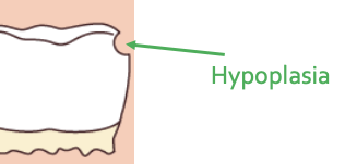 <p>Thickness deficit</p>