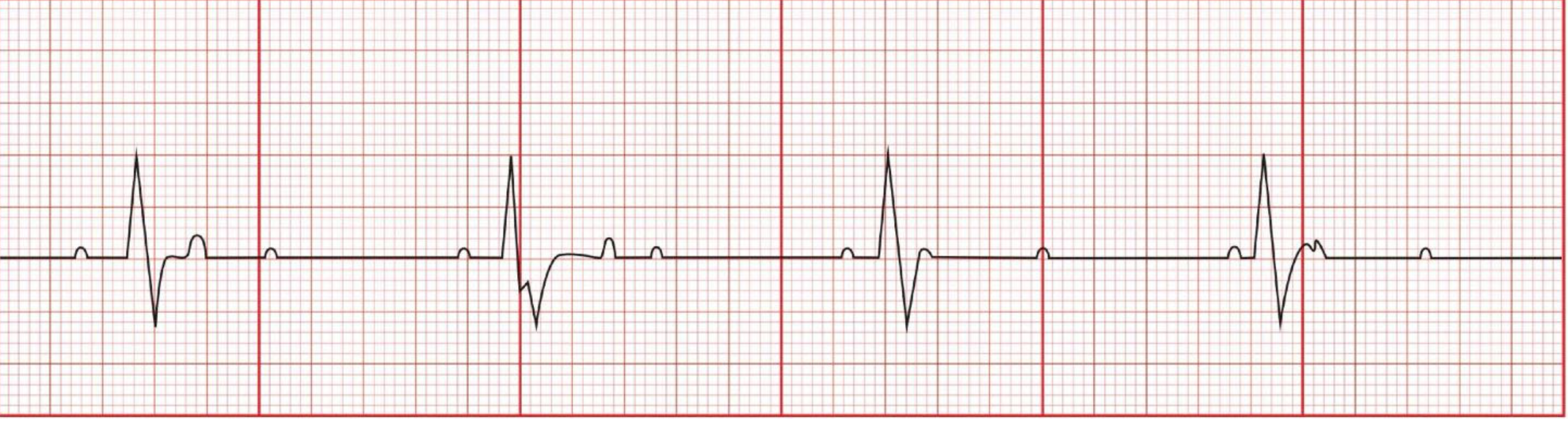 <p>P-wave: Normal</p><p>PR Interval: Variable</p><p>QRS: &lt;0.12</p><p>Rate: &lt;60</p><p>Regularity: Irregular</p><p>complete dissociation between Atria + ventricles, not sufficient enough CO to support VS</p>