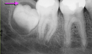<p>Describe this Follicular space</p>