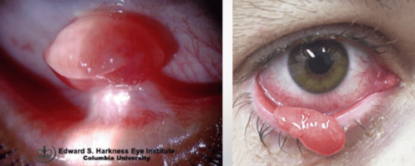 <p>trauma</p><p>post-surgery</p><p>chronic irritation</p>