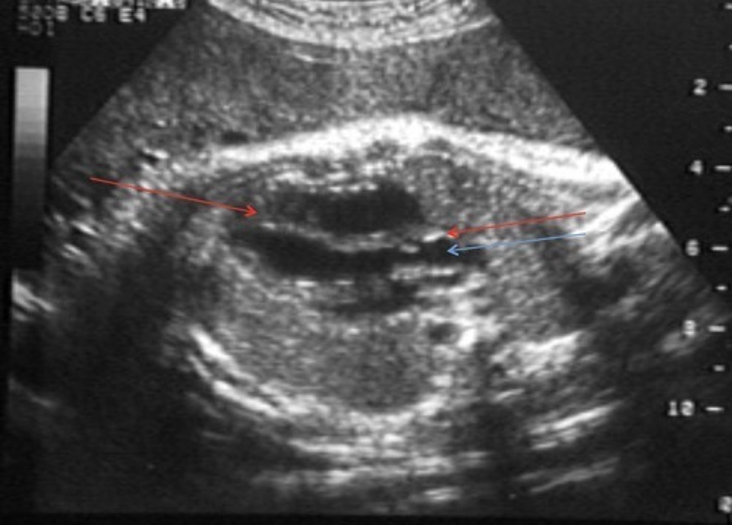 <p>Best seen in LVOT view</p><p>VSD</p><p>Overidding/large AO</p><p>Pulmonary stenosis</p><p>RVH</p>