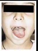 The patient pictured below was asked to “stick your tongue straight out”, but the tongue deviated to the left. Unilateral damage to which cranial nerve could account for this movement impairment?

 A. right trigeminal nerve
 B. left hypoglossal nerve
 C. left glossopharyngeal nerve
 D. left abducens nerve
 E. right facial nerve