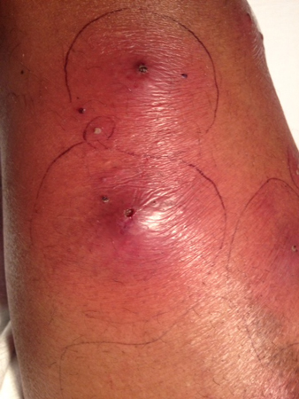 <p><span><span>a type of infectious bacteria that is highly resistant to conventional treatments such as antibiotics. Appears as a skin infection, resulting in pimples, rashes, or boils that can be difficult to cure. Can become systemic/ fatal without proper treatment.</span></span></p>