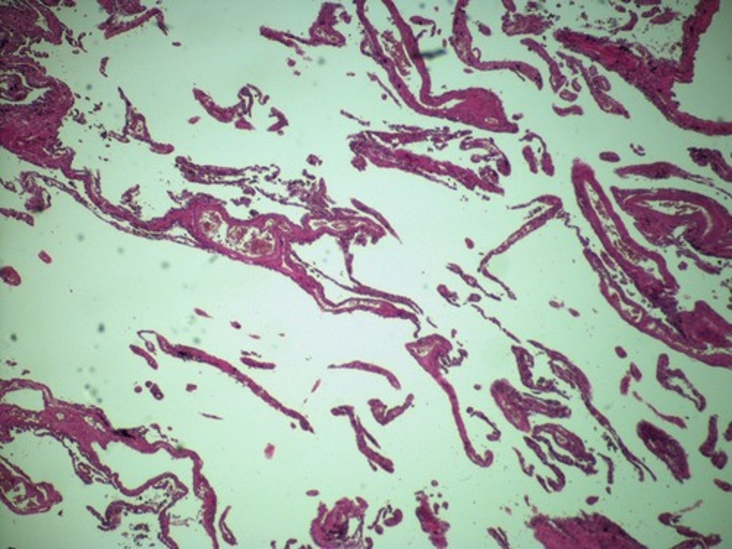 <p>Is this lung biopsy from a person with pneumonia, emphysema, or pulmonary edema?</p>