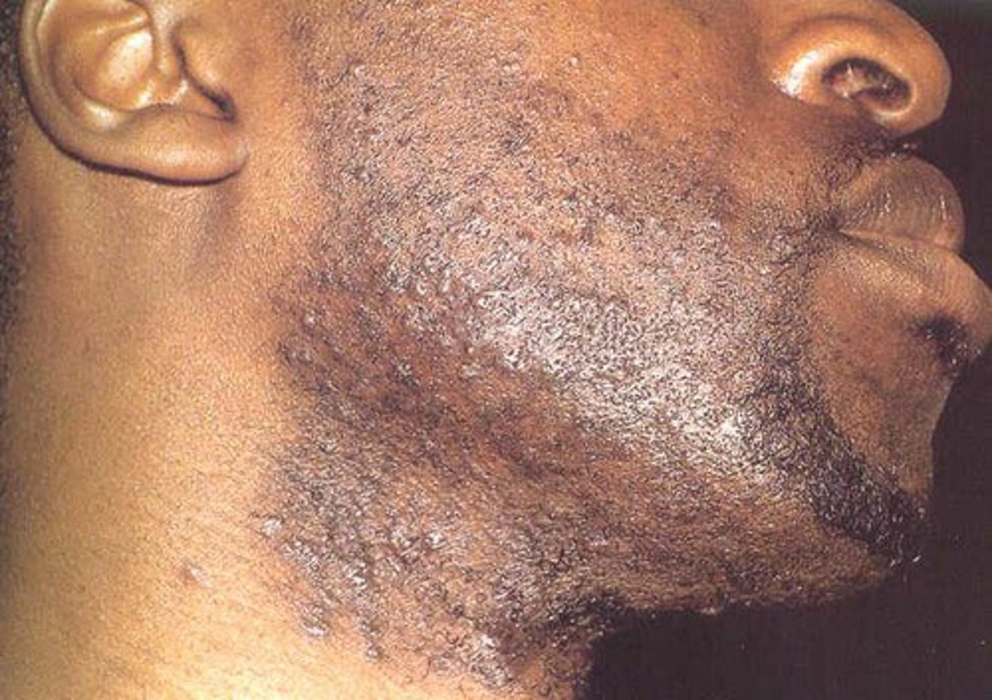 <p>Met welke aandoening moet een differentiaaldiagnose worden gemaakt in geval van folliculitis?</p>