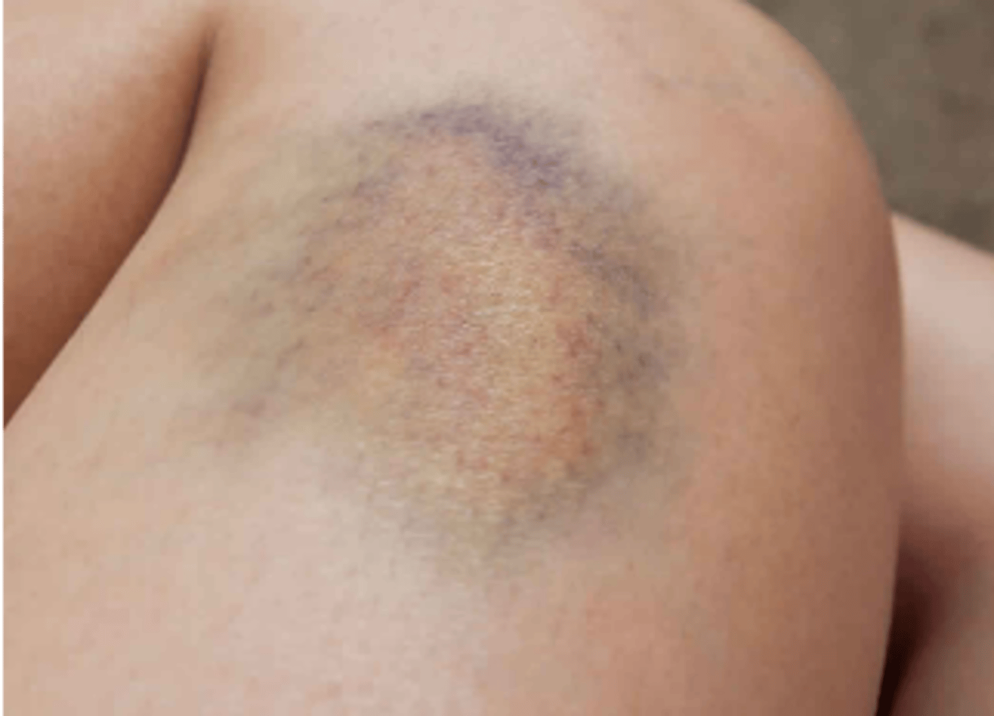 <p>Purple or blue macules caused by trauma, fade over time, &gt;10mm</p>