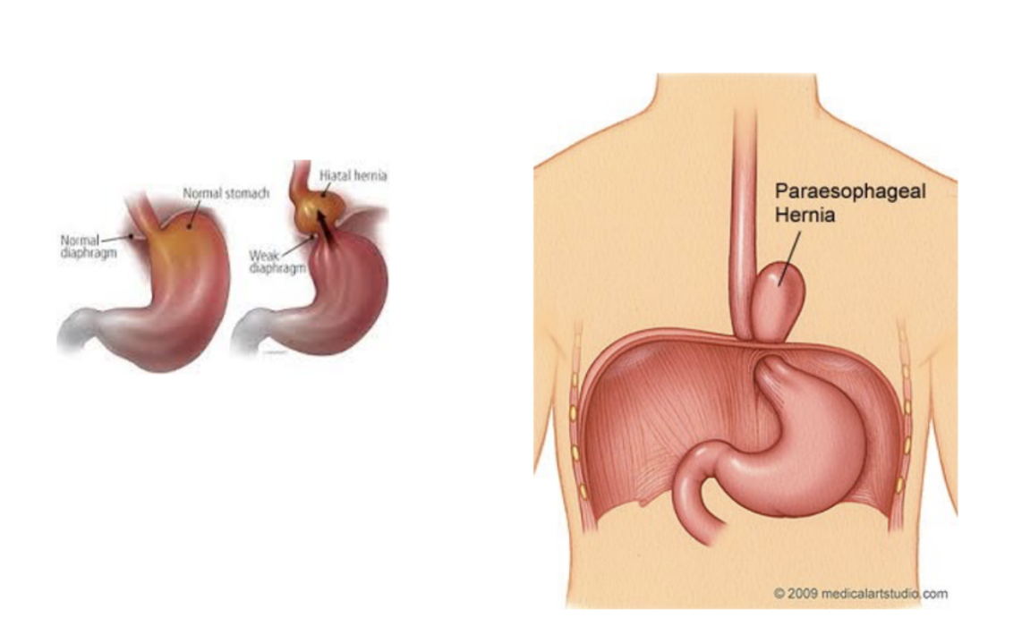 <p>Occurs when part of the stomach slides through esophageal hiatus (opening of diaphgram) — 2 types — </p><ul><li><p>Paraesophageal —</p><ul><li><p>Fundus of stomach herniates — no reflux (cardia remains in normal position)</p></li></ul></li><li><p>Sliding hital — </p><ul><li><p>Reflux — esophagus &amp; cardia slide through hiatus</p></li></ul></li></ul>