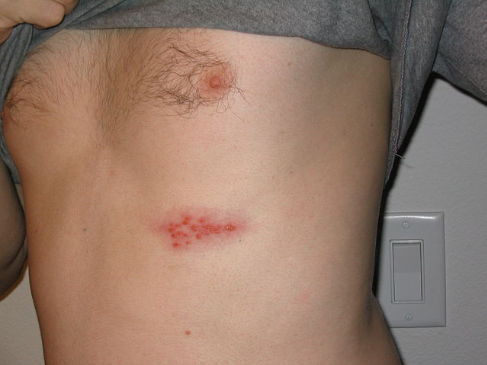 <ul><li><p>Tingling feeling</p></li><li><p>Erythematous papules within a few days→ fluid filled vesicles→ bursts and crusts</p></li><li><p>Painful rash</p></li></ul><p></p>