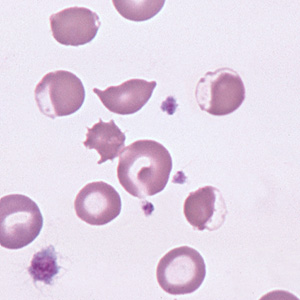 <p>are red cells w a ragged appearing, poorly hemoglobinized fringe of cytoplasm on one side of the cell</p>