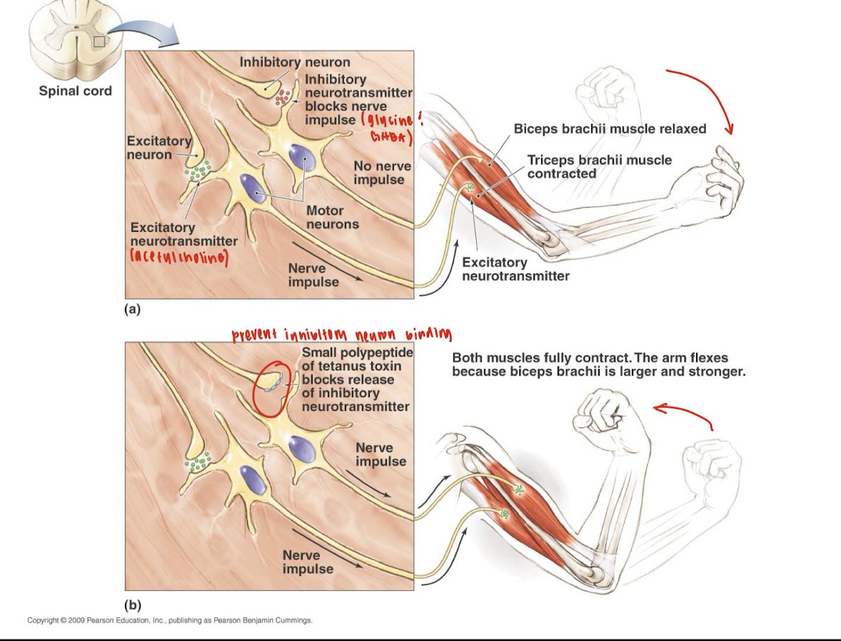 <p>Tetanus toxin interferes with normal neuronal signaling by <strong>blocking the release of inhibitory neurotransmitters</strong> (such as <strong>glycine</strong> and <strong>GABA</strong>) from <strong>inhibitory interneurons</strong> in the spinal cord.</p><p>Normally, inhibitory neurons prevent excessive muscle contraction by <strong>inhibiting motor neurons</strong>. When tetanus toxin blocks this inhibition:</p><ul><li><p><strong>Inhibitory control is lost</strong></p></li><li><p><strong>Motor neurons remain overactive</strong></p></li><li><p>This causes <strong>simultaneous contraction of opposing muscles</strong> (e.g., both biceps and triceps)</p></li><li><p>Leading to <strong>muscle rigidity and spasms</strong>, a hallmark of <strong>tetanus</strong>.</p></li></ul><p></p>