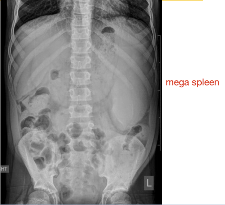 <p><strong>abnormal finding</strong></p><p><em>Abdominal Radiograph</em></p>