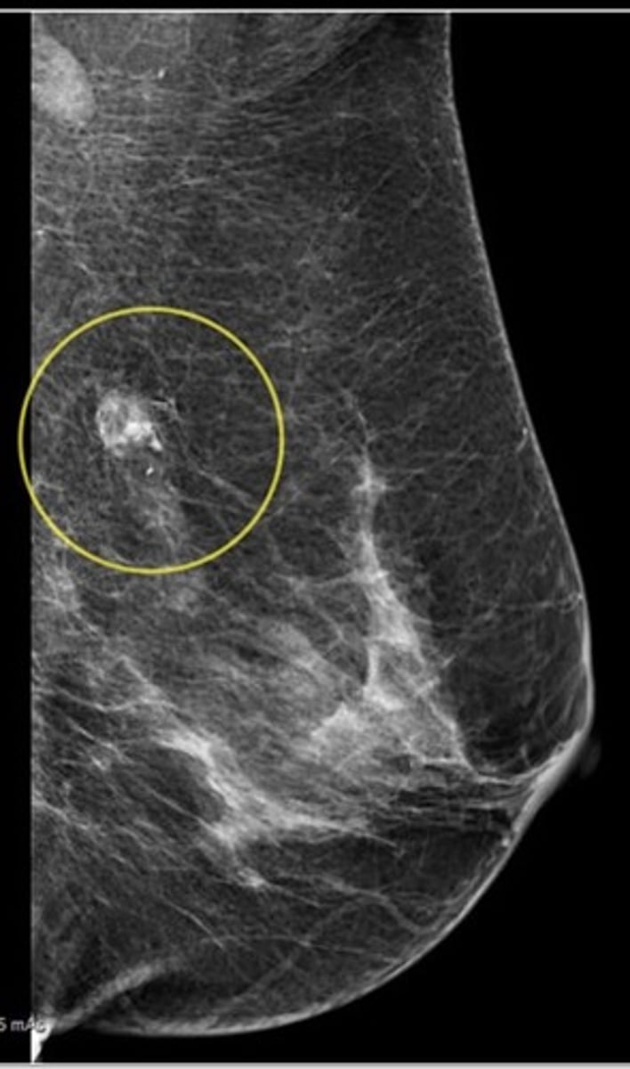 <p>What should you look for on Screening Mammograms?</p>