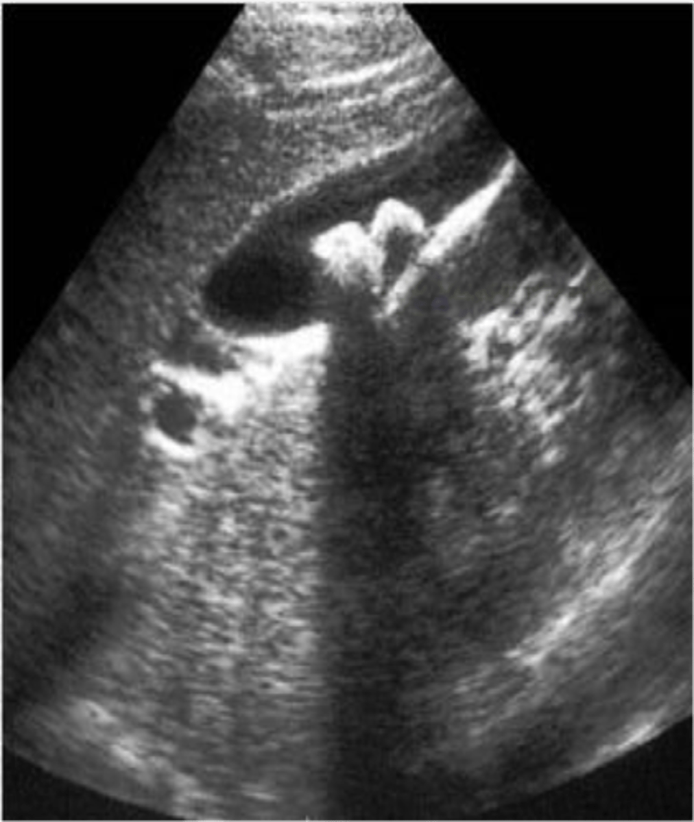 <p>stones in the gallbladder, often asymptomatic, classic biliary pain characterized by infrequent episodes of steady severe pain in epigastrium or RUQ with radiation to R scapula</p><p>echogenic stones, posterior acoustic shadowing</p>