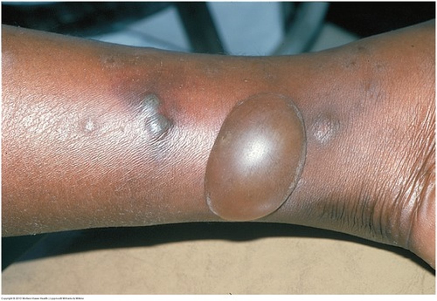 <p>Large Fluid-filled elevation (blisters)</p>