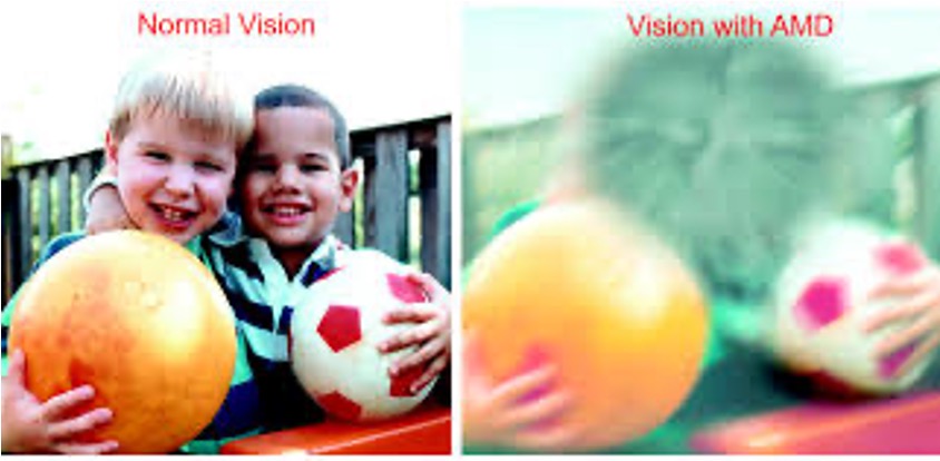 <p>AMD affects central vision because it involves the macula. Peripheral vision is usually unaffected. </p>
