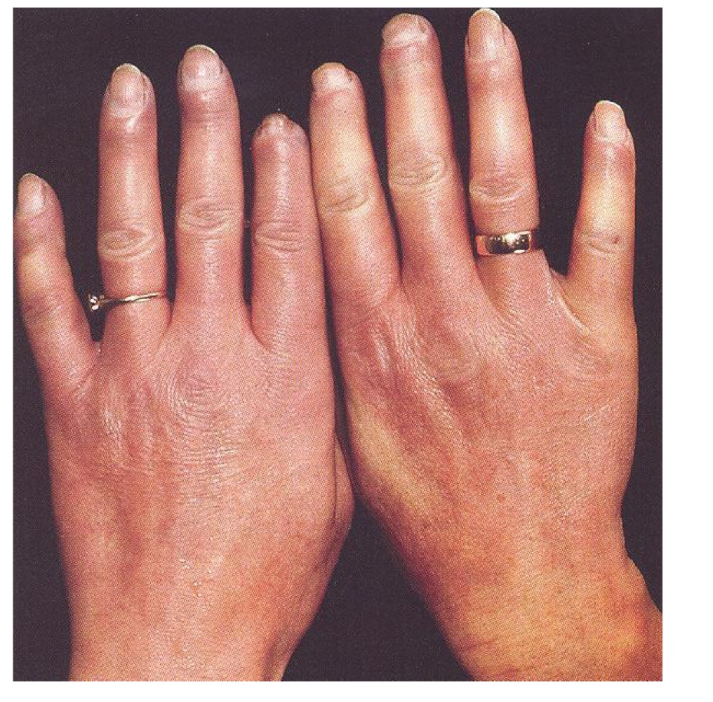 <p>what type of skin lesion is this? </p>