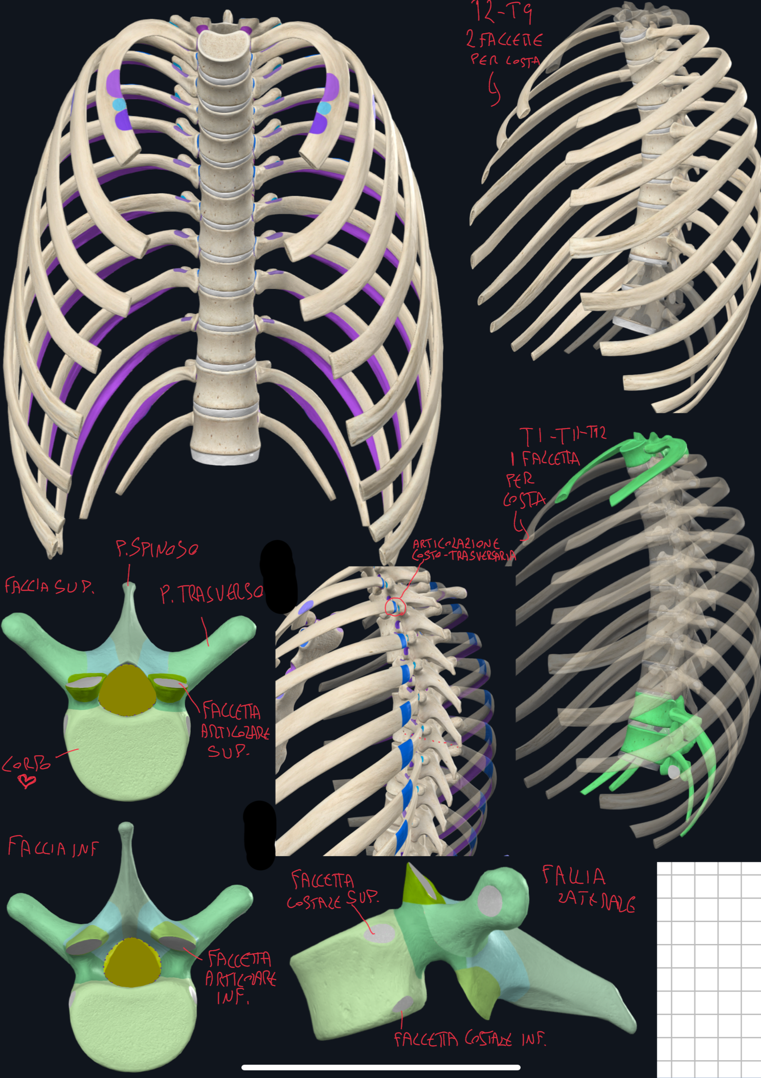 <p>Caratteristiche:</p><ul><li><p>Corpo Vertebrale → forma di cuore, più voluminoso delle cervicali, meno dei lombari</p></li><li><p>Faccette Costali → elemento distintivo:</p><ul><li><p>T1 → ha una faccetta costale superiore intera per articolarsi con la prima costa e poi una inferiore per la seconda</p></li><li><p>T2 a T9 → invece si articolano con due emifaccette → una inferiore sulla vertebra sovrastante e una superiore su quella sottostante → il tutto con il disco intervertebrale incluso tra le due vertebre (T9 in genere ha solo un emifaccetta, in alcune persone entrambe)</p></li><li><p>T10 → anch’essa ha solo una faccetta costale intera per la decima costa</p></li><li><p>T11 e T12  → definite fluttuanti perché si articolano solo con il corpo della vertebra e non con i processi traversi → anche loro hanno solo una faccetta costale intera per la loro costa</p></li></ul></li><li><p>Foro Vertebrale → piccolo e circolare, siccome il midollo spinale qui è più sottile</p></li><li><p>Processi Spinosi → lunghi e inclinati verso il basso, con la punta a livello del corpo vertebrale sottostante</p></li><li><p>Processi Trasversi → robusti, da T1 a T10 hanno faccette articolari per i tubercoli costali, formando l’Articolazione Costo-Trasversaria</p></li><li><p>Faccette Articolari → orientamento:</p><ul><li><p>Superiori → posterolaterali</p></li><li><p>Inferiori → anteromediali</p></li><li><p>Orientamento che consenti i movimenti di rotazione,  quelli di flessione-estensione sono limitati dalla gabbia toracica e articolazioni costali.</p></li></ul></li></ul><p></p>