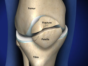 <p>is considered a sesamoid bone because of its resemblance to a sesame seed.</p>