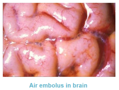 <p>surgical procedures</p><p>intravenous catheterisation</p><p>trauma</p><p>barotrauma (divers come up too quick → alveolar rupture &amp; tearing of pulmonary veins)</p>