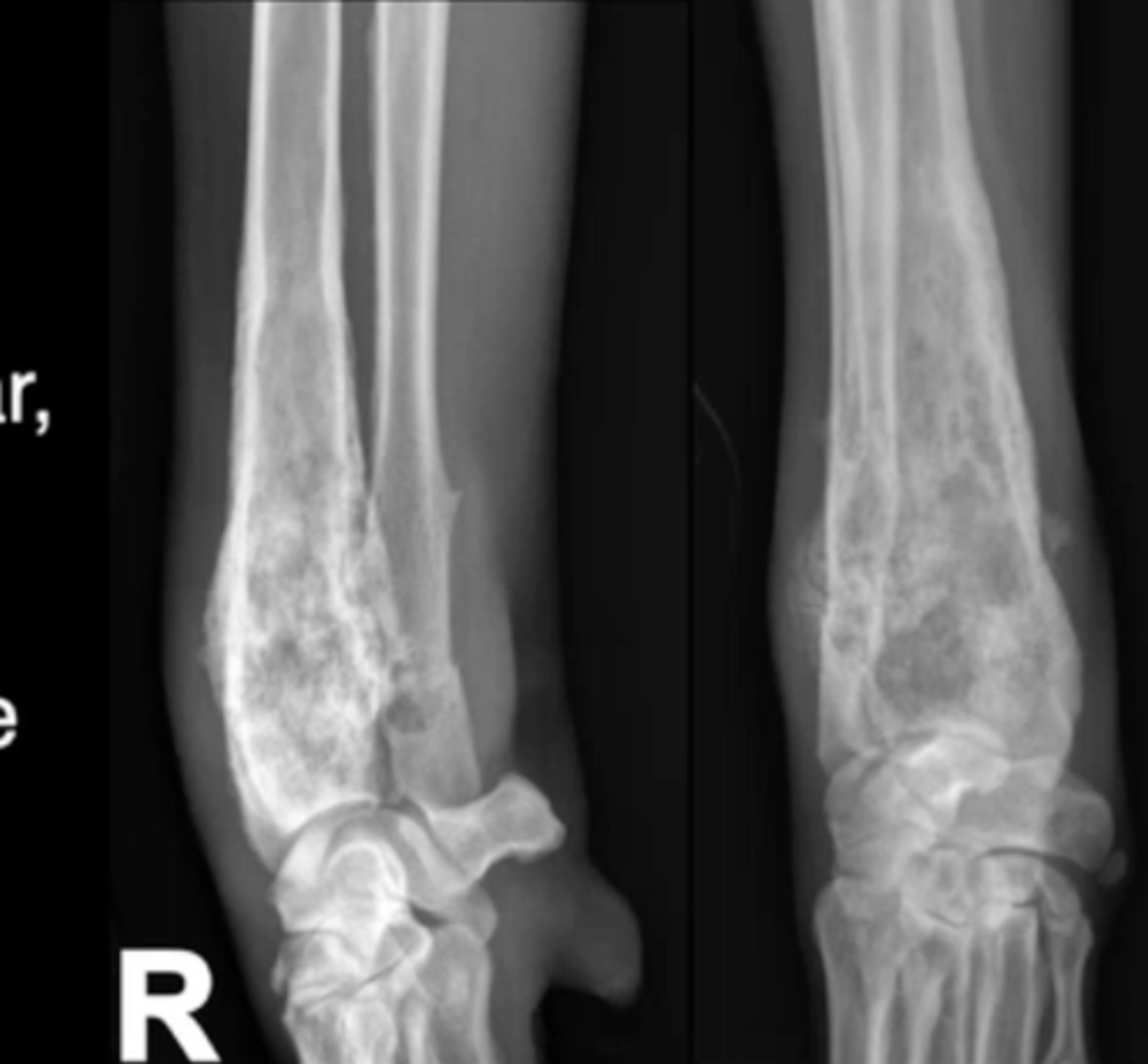 <p>Which pattern of destruction is this?</p>