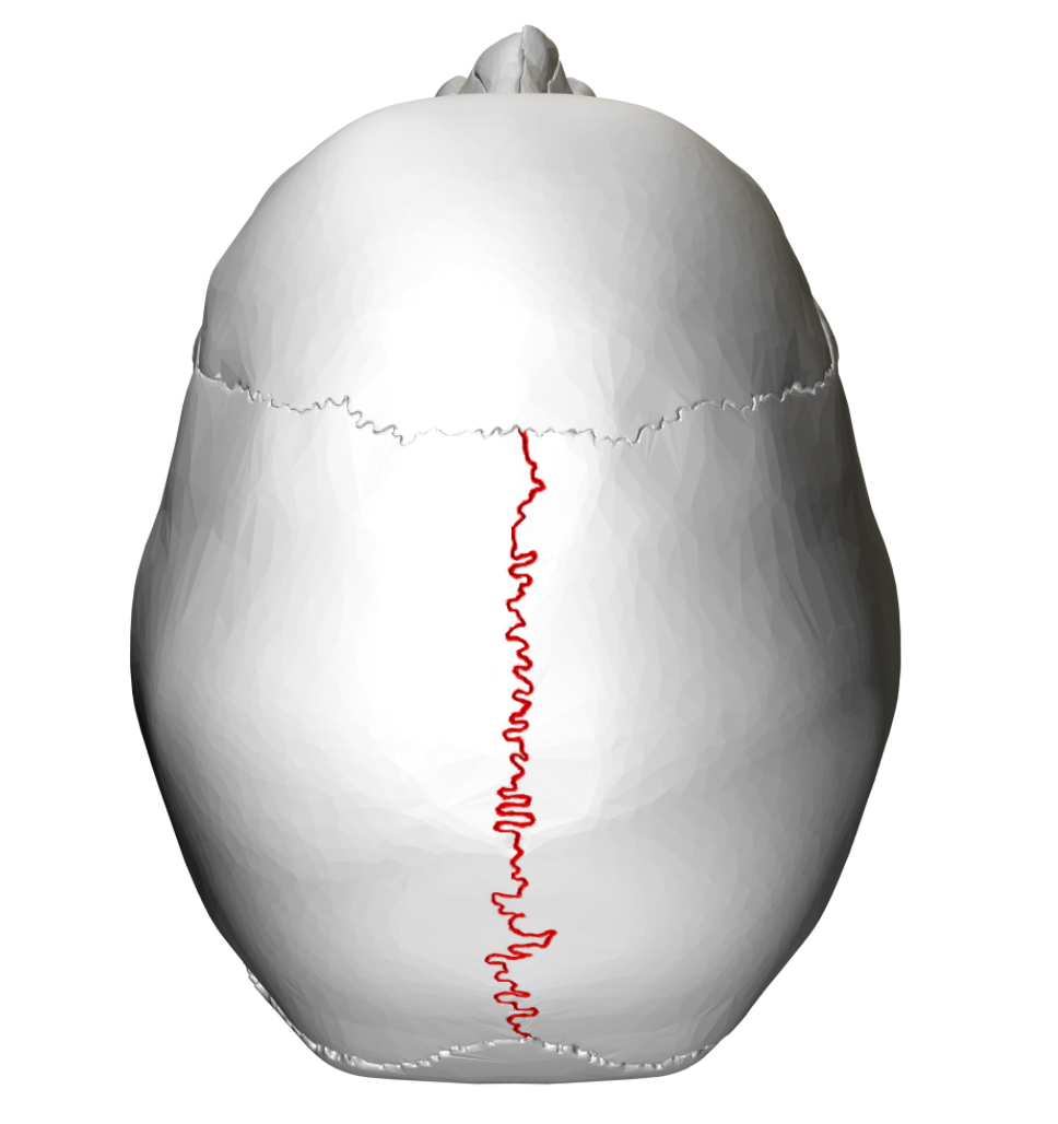 <p>Sagittal suture</p>