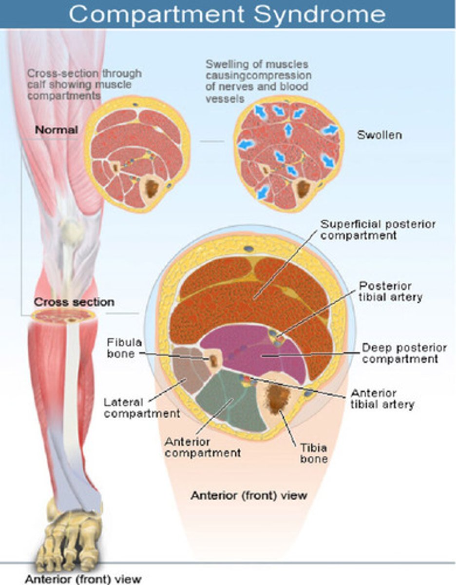 <p>- vascular damage (hemorrhage => risk of hypovolemic shock)</p><p>- infection</p><p>- associated injuries (eg. pneumothorax, CNS injury)</p><p>- thromboembolism</p><p>- compartment syndrome</p>