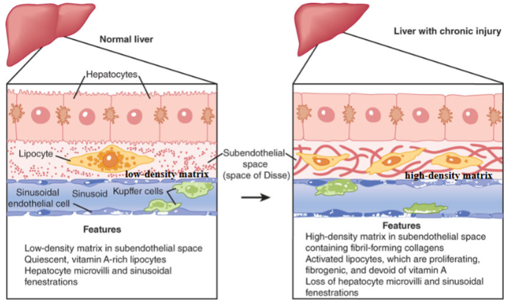 <ul><li><p>Hepatic stellate cells (lipocytes) are normally quiescent but become activated with injury</p></li><li><p>Changes in the hepatic subendothelial space during liver injury. Cellular and matrix alterations in the space of Disse are critical events in the pathogenesis</p><p>of hepatic fibrosis. The activation of lipocytes, characterized by proliferation and increased fibrogenesis, is associated with the replacement of the normal low-density matrix with a high-density matrix. These alterations are likely to underlie, at least in part, the loss of both endothelial fenestrations (pores) and hepatocytic microvilli typical of chronic liver injury.</p></li></ul><p></p>
