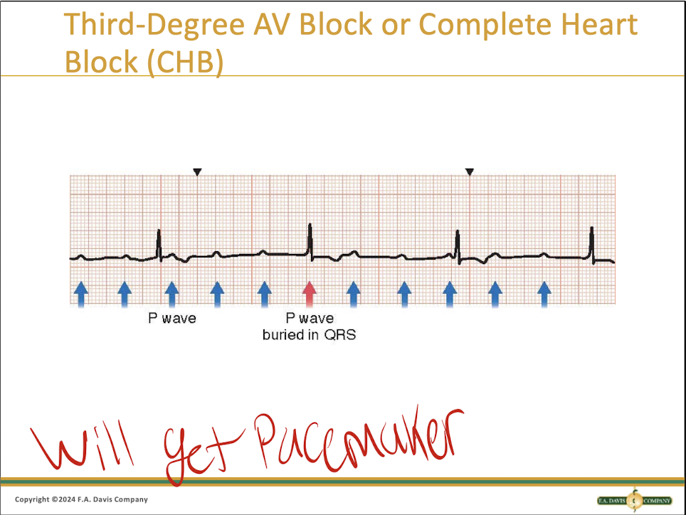 <p>Lines with a quick QRS. THE ONE WITH ARROWS!</p>