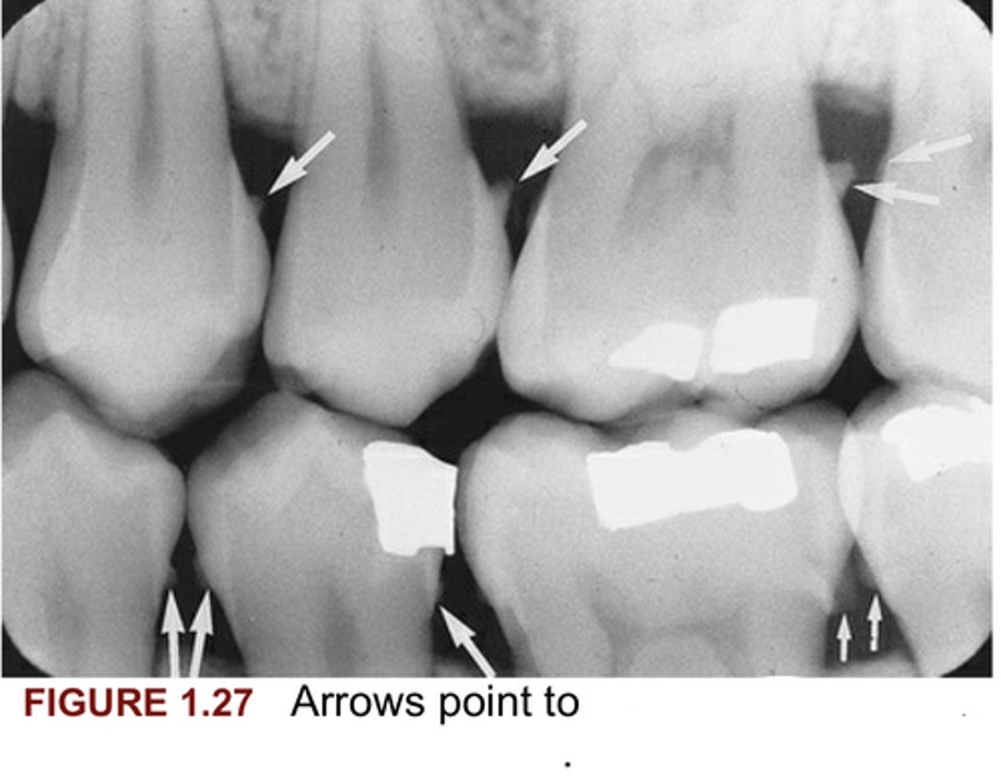 <p>In figure 1.27, arrows point to what?</p>
