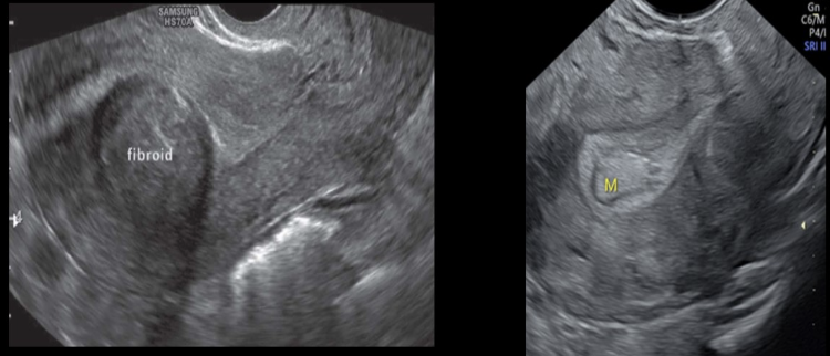 <p>an endometrial polyp is described as</p><p>a) focal hypertrophy of the endometrium</p><p>b) stage 1 of endometrial adenocarcinoma</p><p>c) malignant overgrowth of the endometrial tissue</p><p>d) stage 1 of PID</p>