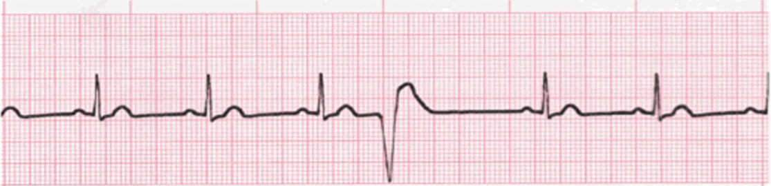 <p>What does this EKG represent?</p>