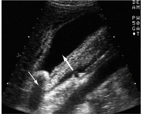 <p>Abd US → gallbladder wall thickening, cystic duct dilation </p>