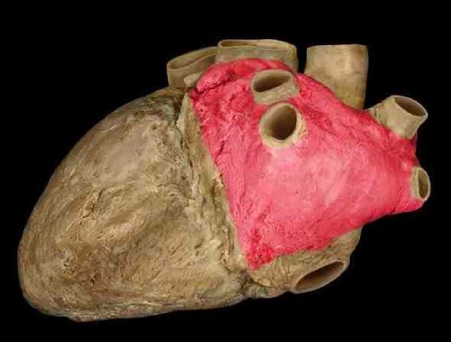 <p>collective space; 2 probes in, parallel, across 2 loops, across left atrium</p><p>H6</p>