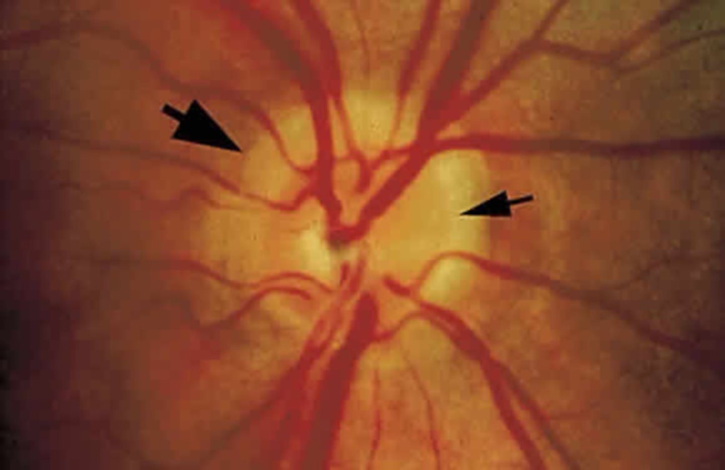 <p>double ring sign = outer yellow sclera, inner pigmented ring around ONH</p><p>margins may be blurred due to too many crowded axons</p><p>NOTE: these findings are not that common</p>