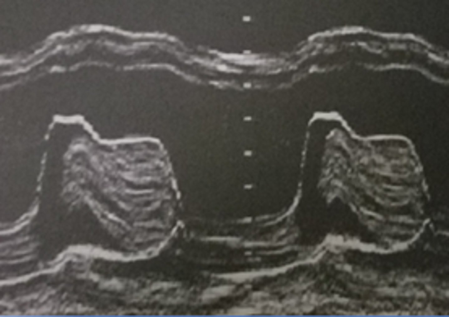 <p>a benign cardiac tumor usually attached to the IAS</p>