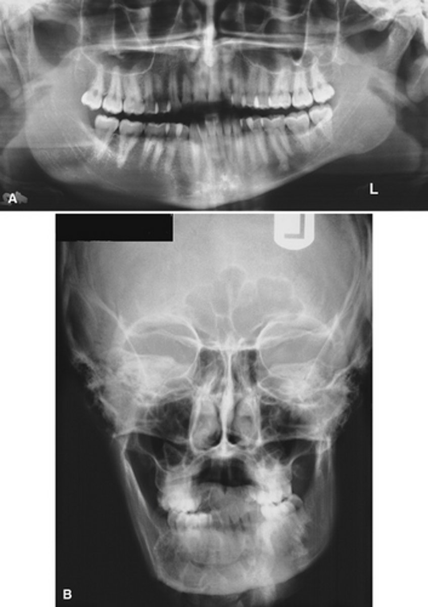 <p>What is this developmental abnormality, and what is the etiology for it?</p>
