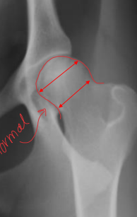 <p>Hip Dysplasia</p>